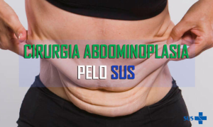 Abdominoplastia pelo SUS: Quem tem Direito e Como dar Entrada?